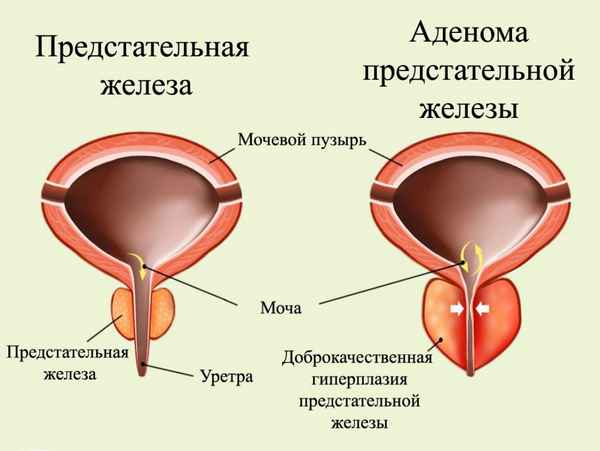 Гипертензия предстательной железы
